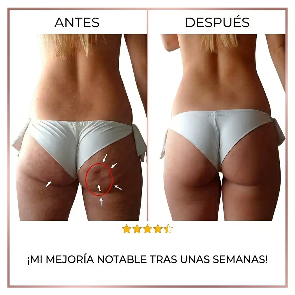 Redulitis Lift Pro - Dispositivo Anticelulítico y Reafirmante