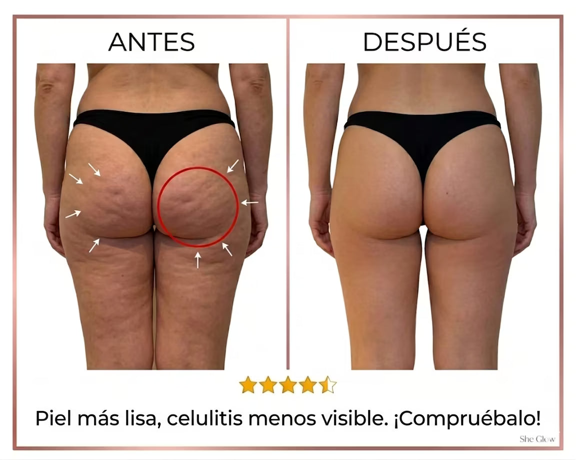 Redulitis Lift Pro - Dispositivo Anticelulítico y Reafirmante